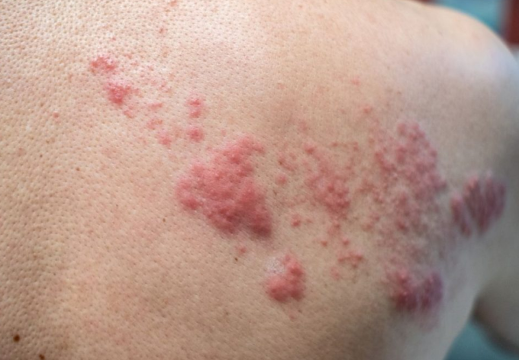 Shingles rash on the back of a patient
